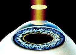 Рис.2 - калибровка оптической силы глаза путем испарения поверхности роговицы