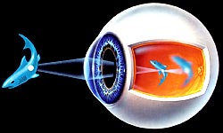 Рис.6 - При миопии или близорукости четкое изображение строится перед сетчаткой глаза